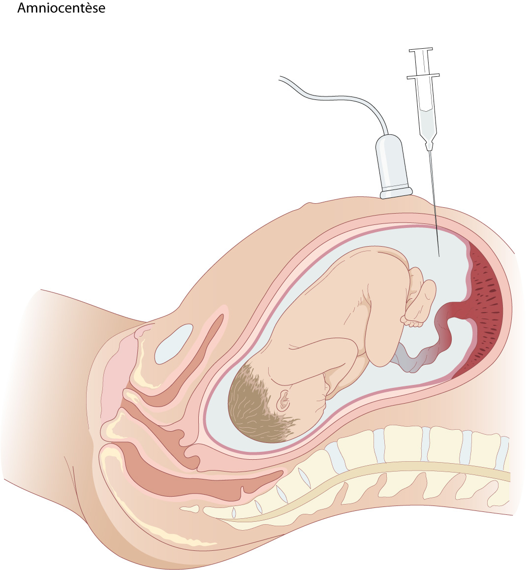 J'ai une descente d'organes. Que se passe-t-il et que faire?